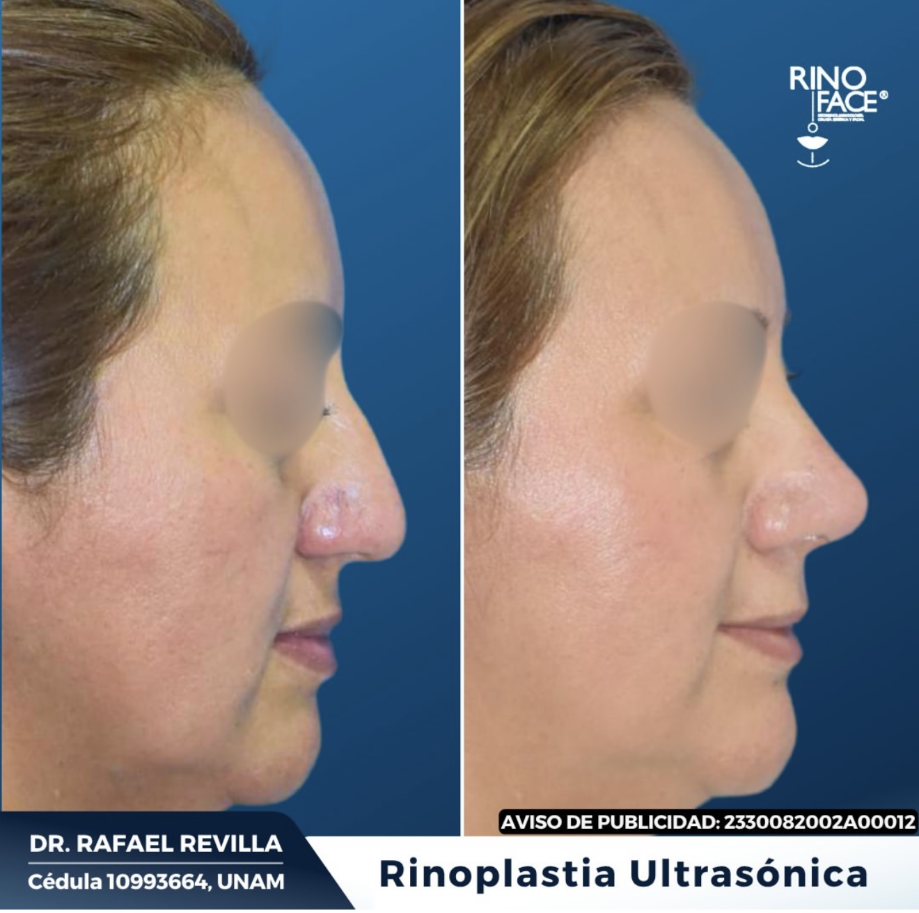 RinoFace Rinologia y cirugía facial 